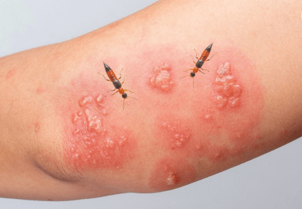 Kiến ba khoang cắn - Rửa sạch và làm dịu đúng cách Kiến ba khoang cắn - Rửa sạch và làm dịu đúng cách