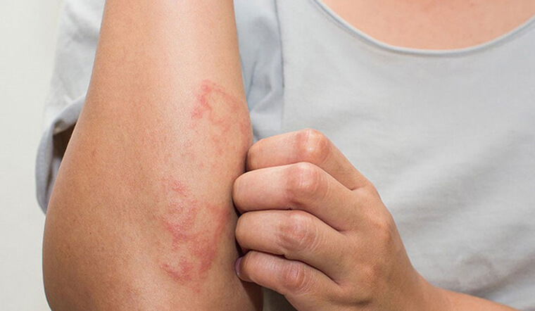 Kiến ba khoang cắn - Cơ chế viêm da do tiếp xúc, không phải vết đốt Kiến ba khoang cắn - Cơ chế viêm da do tiếp xúc, không phải vết đốt