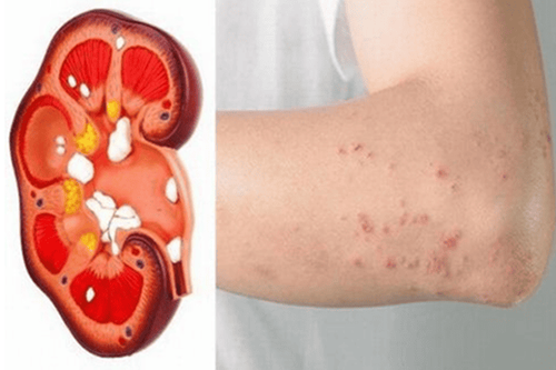 Dấu hiệu suy thận - Nhận biết sớm dấu hiệu suy thận để điều trị hiệu quả Dấu hiệu suy thận - Nhận biết sớm dấu hiệu suy thận để điều trị hiệu quả