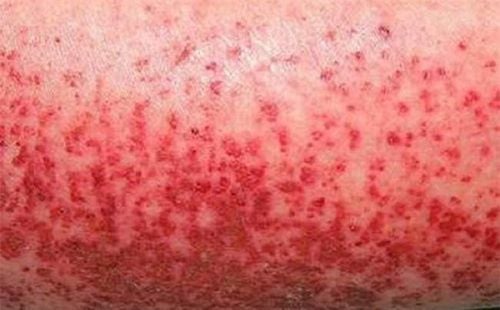 Triệu chứng sốt xuất huyết - Khác gì với cảm cúm thông thường Triệu chứng sốt xuất huyết - Khác gì với cảm cúm thông thường