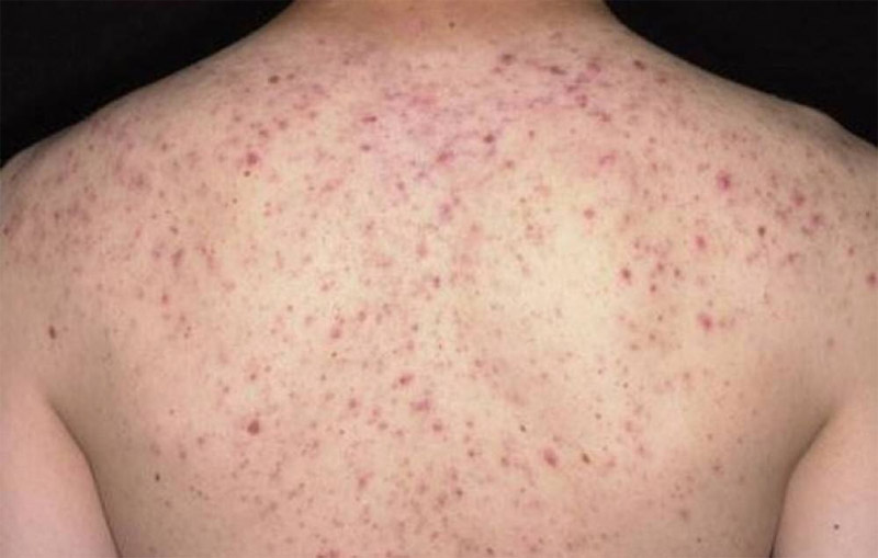 Viêm nang lông - Những thói quen dễ làm tái phát Viêm nang lông - Những thói quen dễ làm tái phát